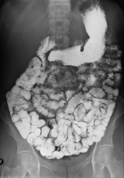 416px-Smallbowel.jpg