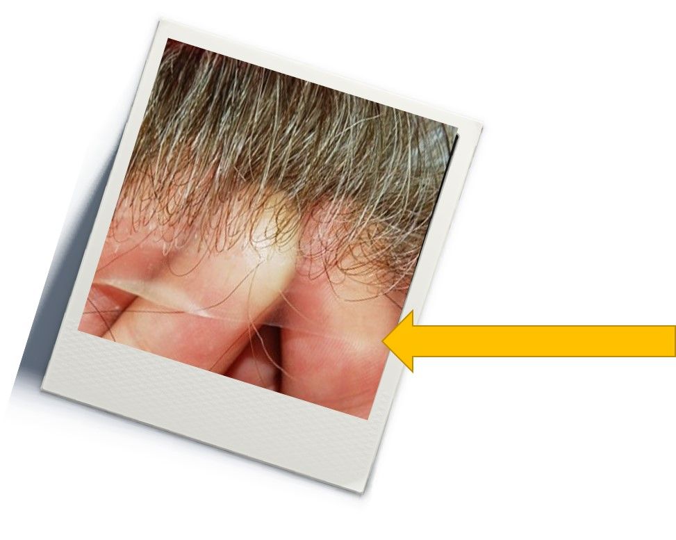 5. Hairline fo a Thin Skin Wig Cap.jpg
