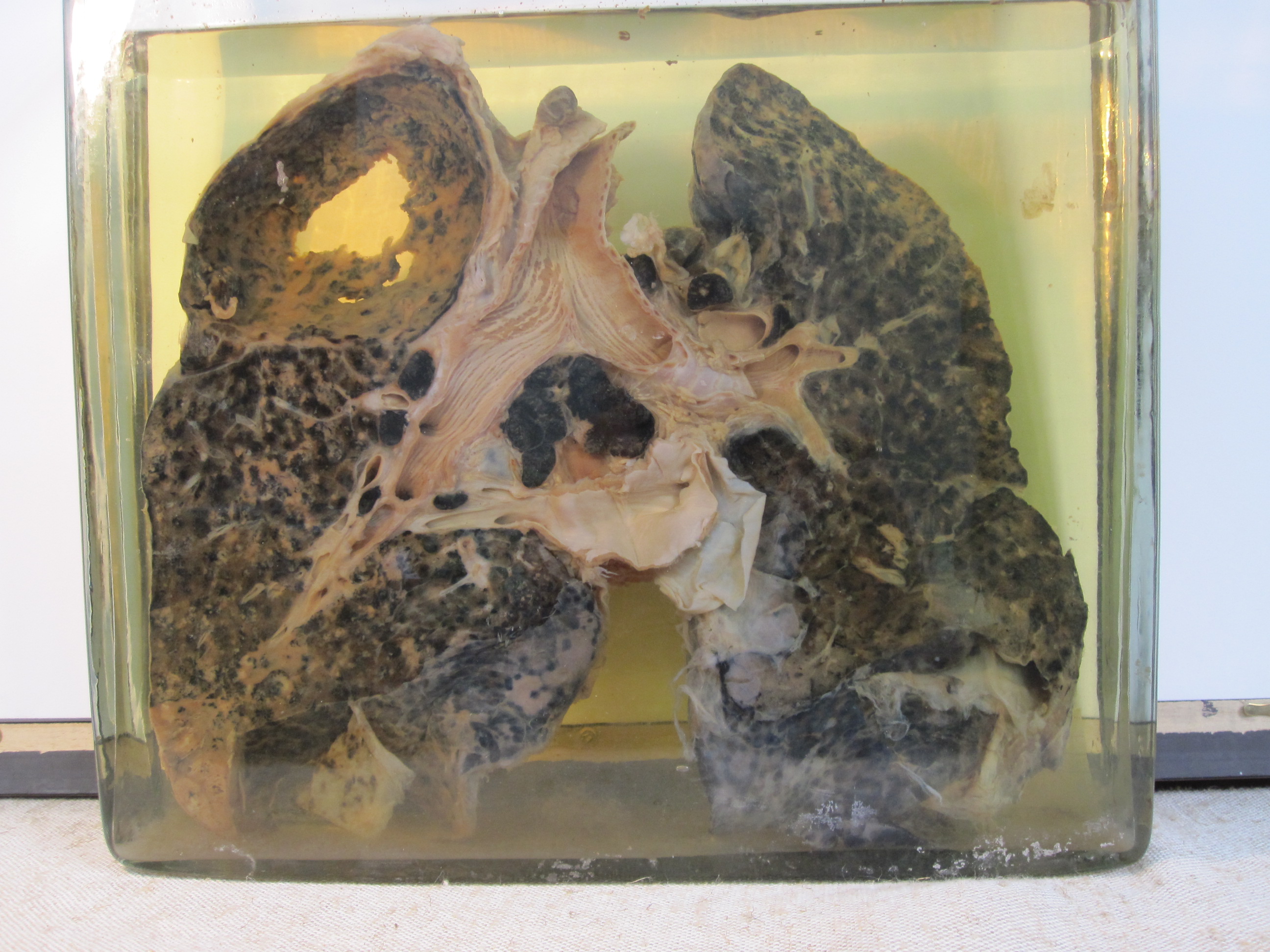 8.-_Miner's_lung_with_silicosis_and_tuberculosis.jpg