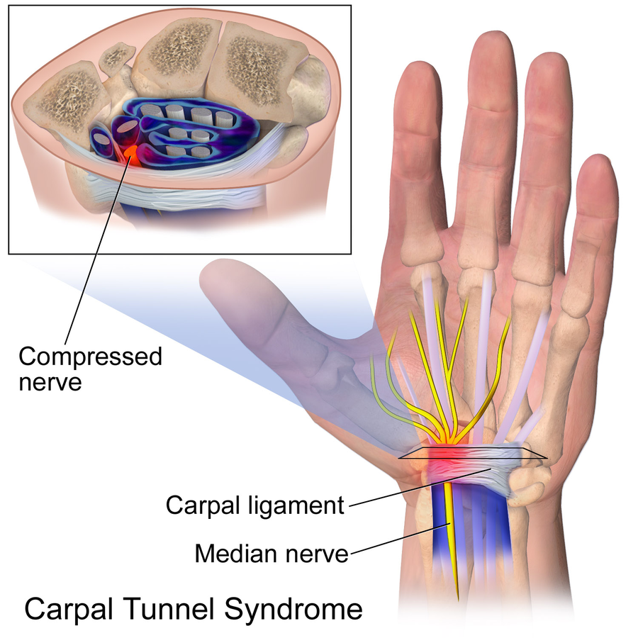 900px-Carpal_Tunnel_Syndrome.png