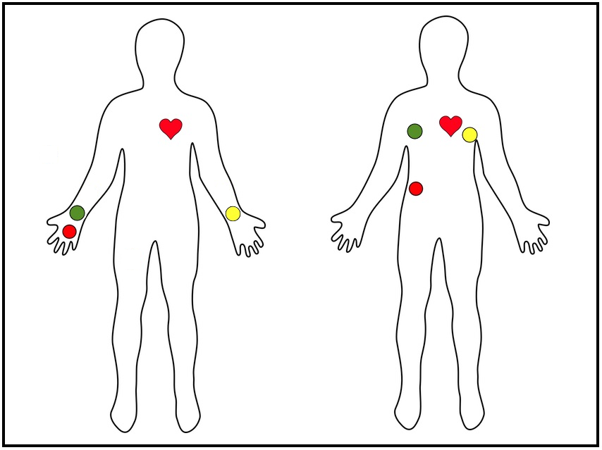 ECG Electrodes.jpg