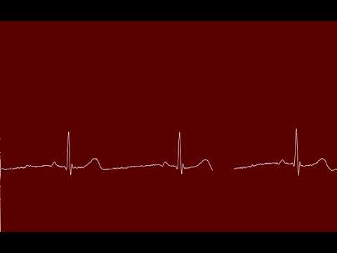 EKG real