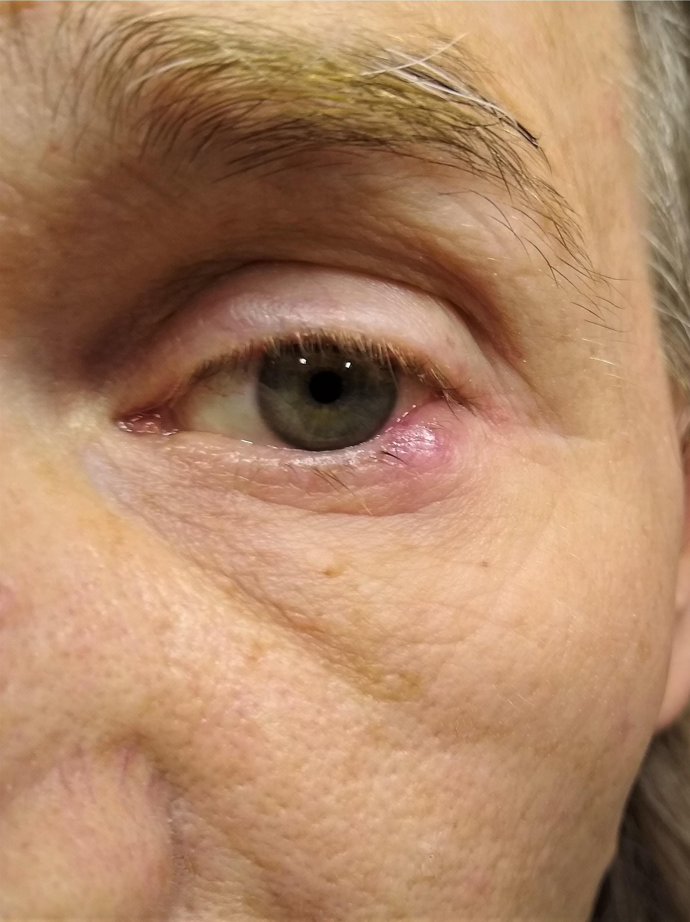 Stye1.jpg