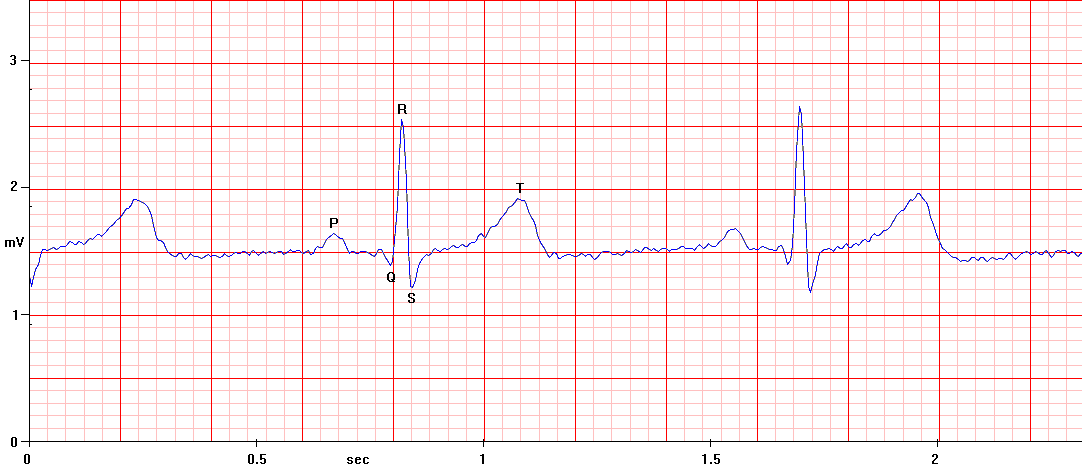 first ecg.PNG