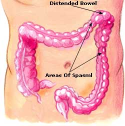 irritable-bowel-syndrome-ibs-picture.jpg