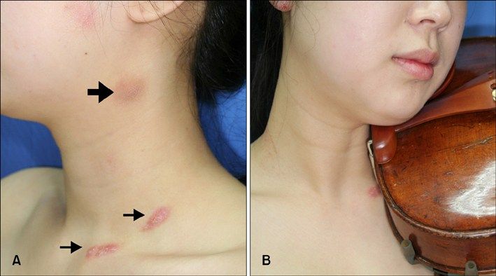 neck infection from violin.jpg