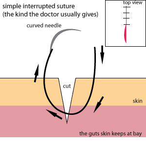 simple_interrupted_suture.png