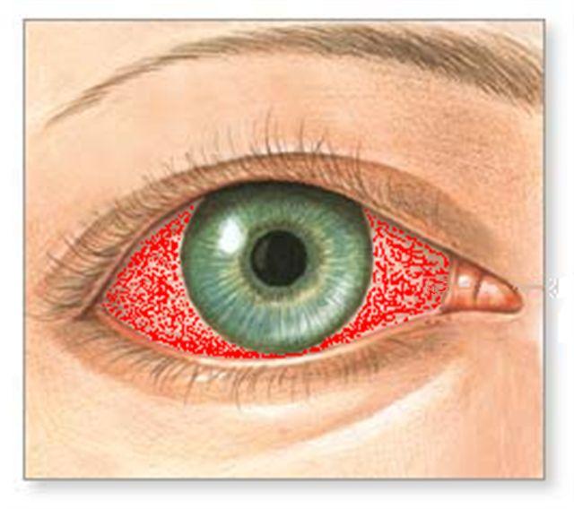 C:\Documents and Settings\phantom\My Documents\My Pictures\TAMPA\1911 E Clinton St\COMPUTER\WEB\INSTRUCTABLES\WATERMELON\emergency face mask\bloodshot eye (Small).jpg