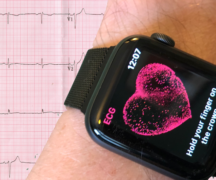 Simulate a 12-Lead ECG With Apple Watch Series 4 or later